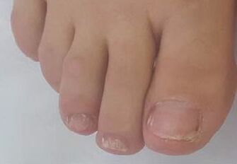 Promicil cured advanced onychomycosis