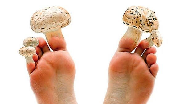 Toenail fungus that can be prevented