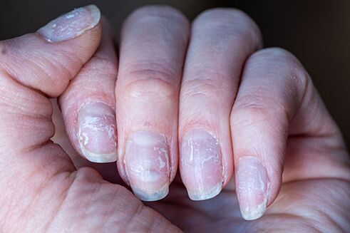 fungus on nails