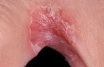 Fungus on the legs between the fingers