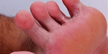 The fungus on the legs