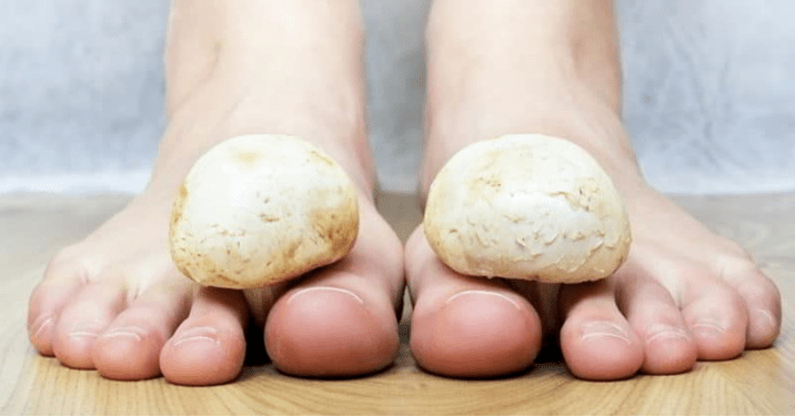 Quick treatment of fungus on the legs at home