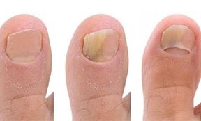 Stages of development of the fungus on the thumb of the leg