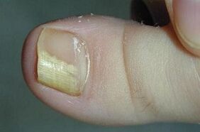 The reasons for the appearance of the fungus on the thumb of the leg