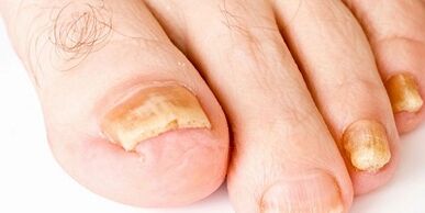 how and how to cure nail fungus