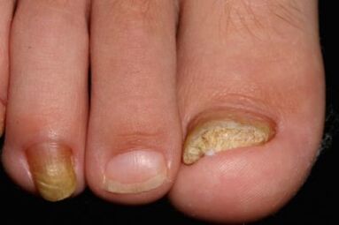 Micosis of nails on the legs