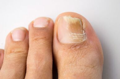 Mycosis caused by yeast microorganisms