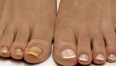 The causes of the appearance of the fungus on the nails
