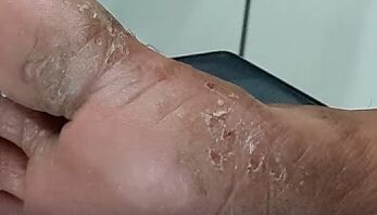 types and forms of fungus on the toes